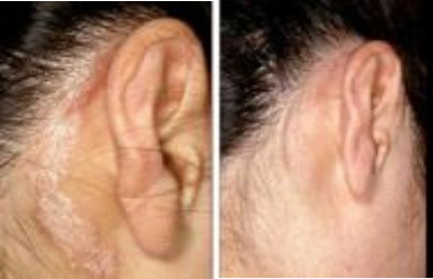 Scalp & Ear Psoriasis Before & After