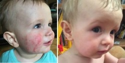 Baby's Facial Eczema Before & After