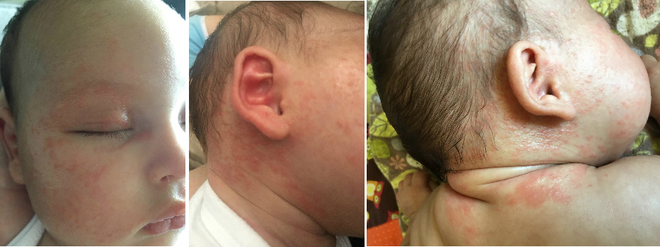 Infant Facial Seborrheic Dermatitis Before