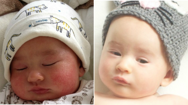 Baby Eczema Before & After