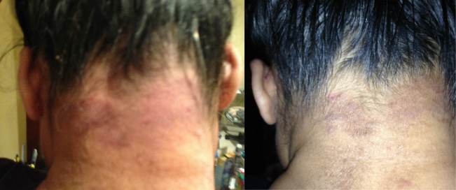 Eczema Before & After