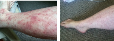 Leg Eczema & Rash Before & After