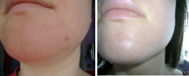 Facial Seborrheic Dermatitis Before & After