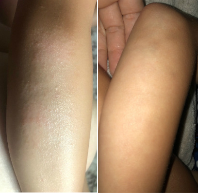 Red Itchy Bumps On Arm Before & After