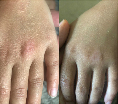 Red Itchy Bumps On Hands Before & After