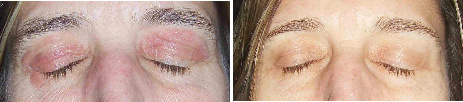 Itchy Eyelids Before & After