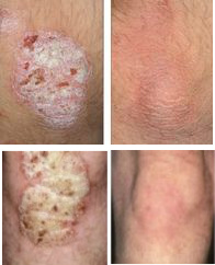 Elbow & Knee Psoriasis Before & After